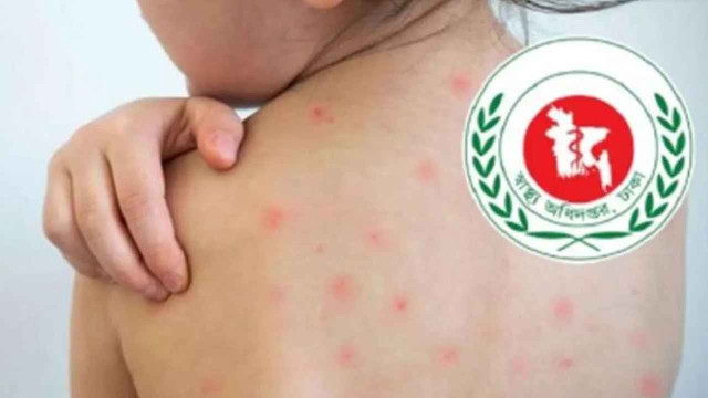 হাম ও হাম উপসর্গে শিশুমৃত্যু ১১০০ ছাড়িয়েছে